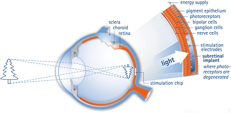 Retinal-medical Implant