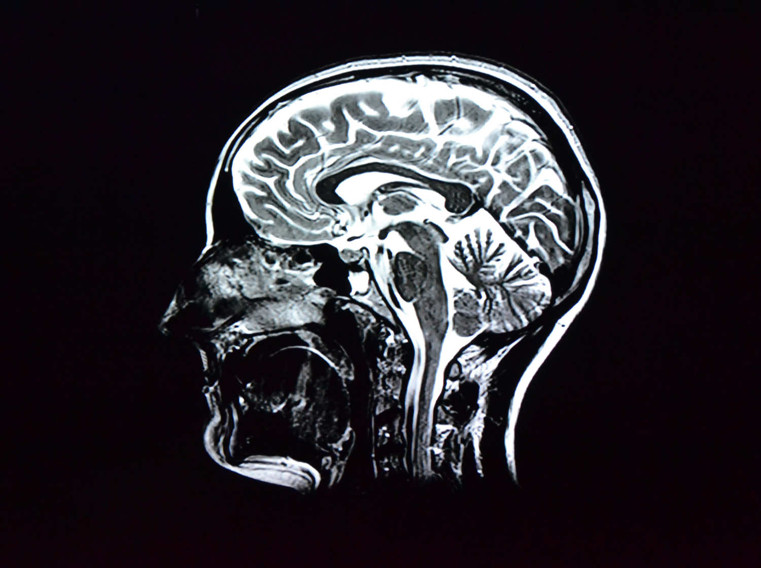 medical brain implant