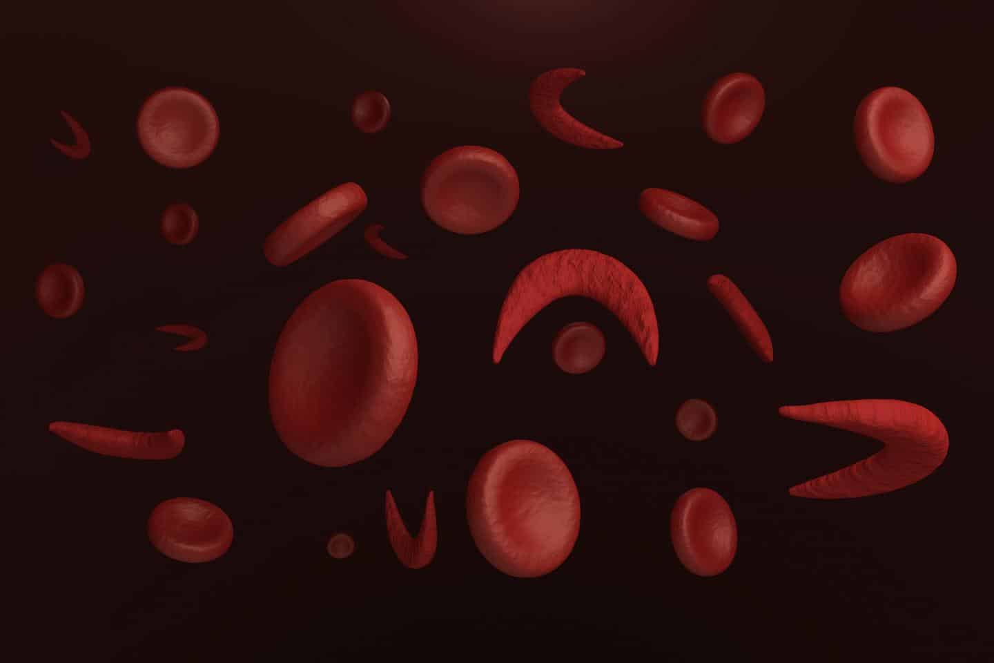 Sickle-cell Anemia - human mutation