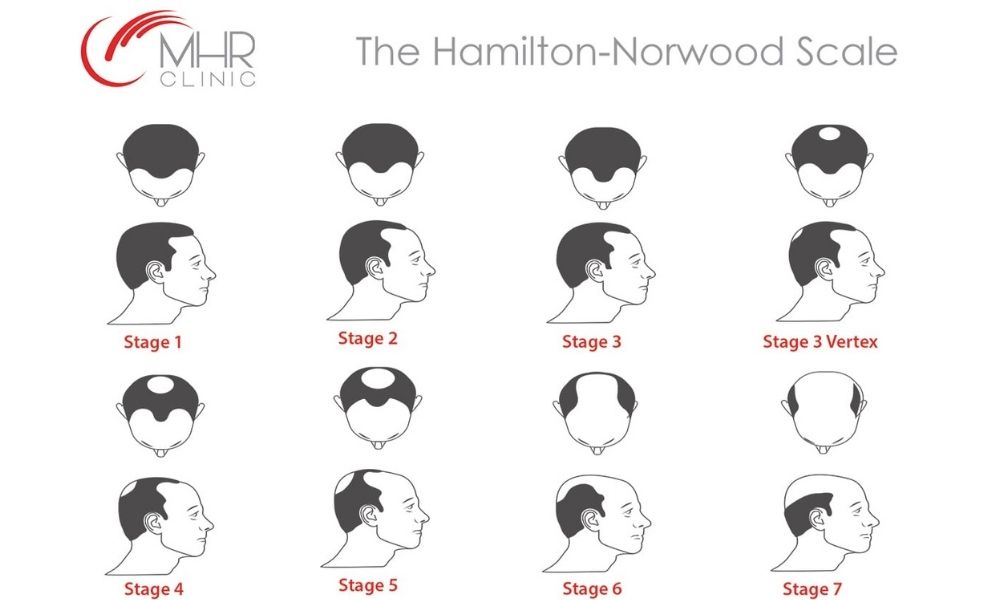 Norwood Scale - Mature hairline