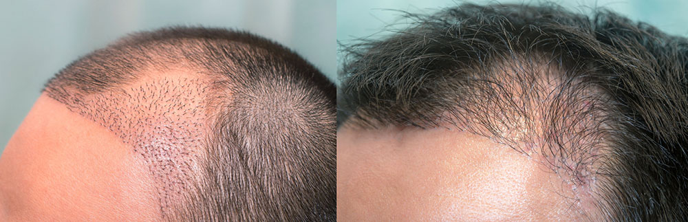 Hair-Transplant-Surgery-Before-After