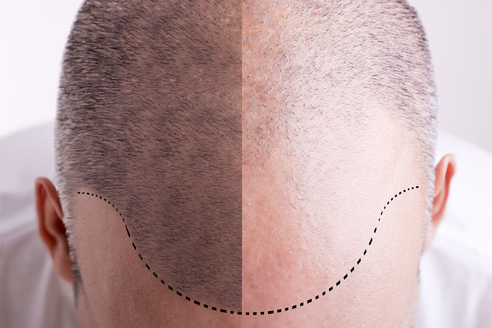 Mature-vs-Receding-Hairline
